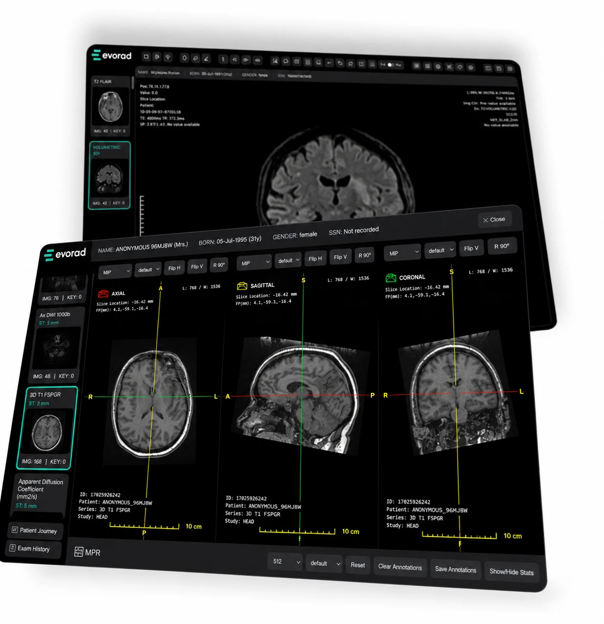 The Evorad viewer showing axial, sagittal and coronal MRI views of the brain in front of a second study